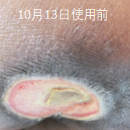 四期褥疮（臀部信阳）