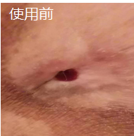 褥疮7cm窦道