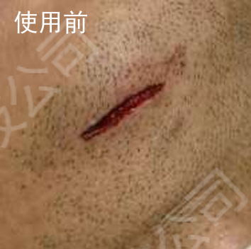 下巴磕伤