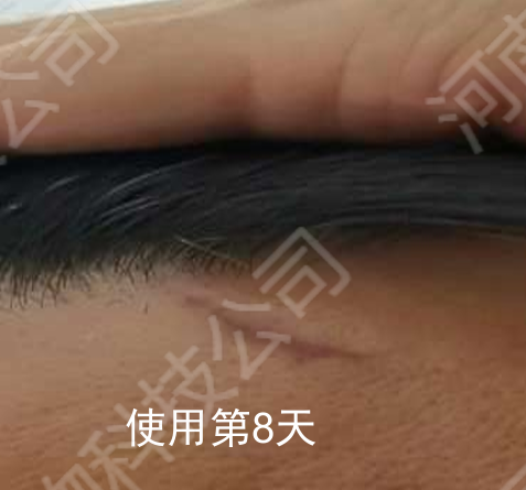 额头皮肤缺损无痛无疤愈合
