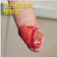 手指切伤