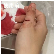 拇指剪伤