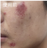 面部磕伤