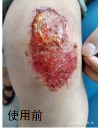 膝盖磕伤后发炎