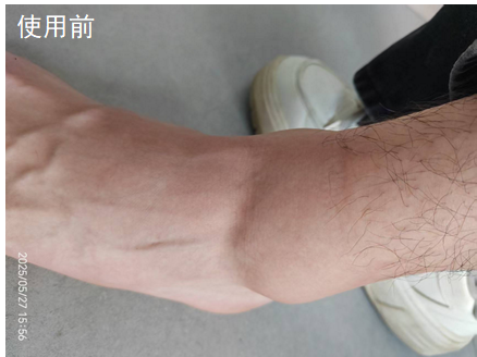 脚踝扭伤