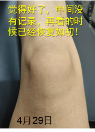 膝关节磕伤