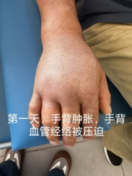 手部软组织感染
