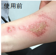 胳膊擦伤发炎创面