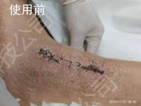 骨折术后伤口