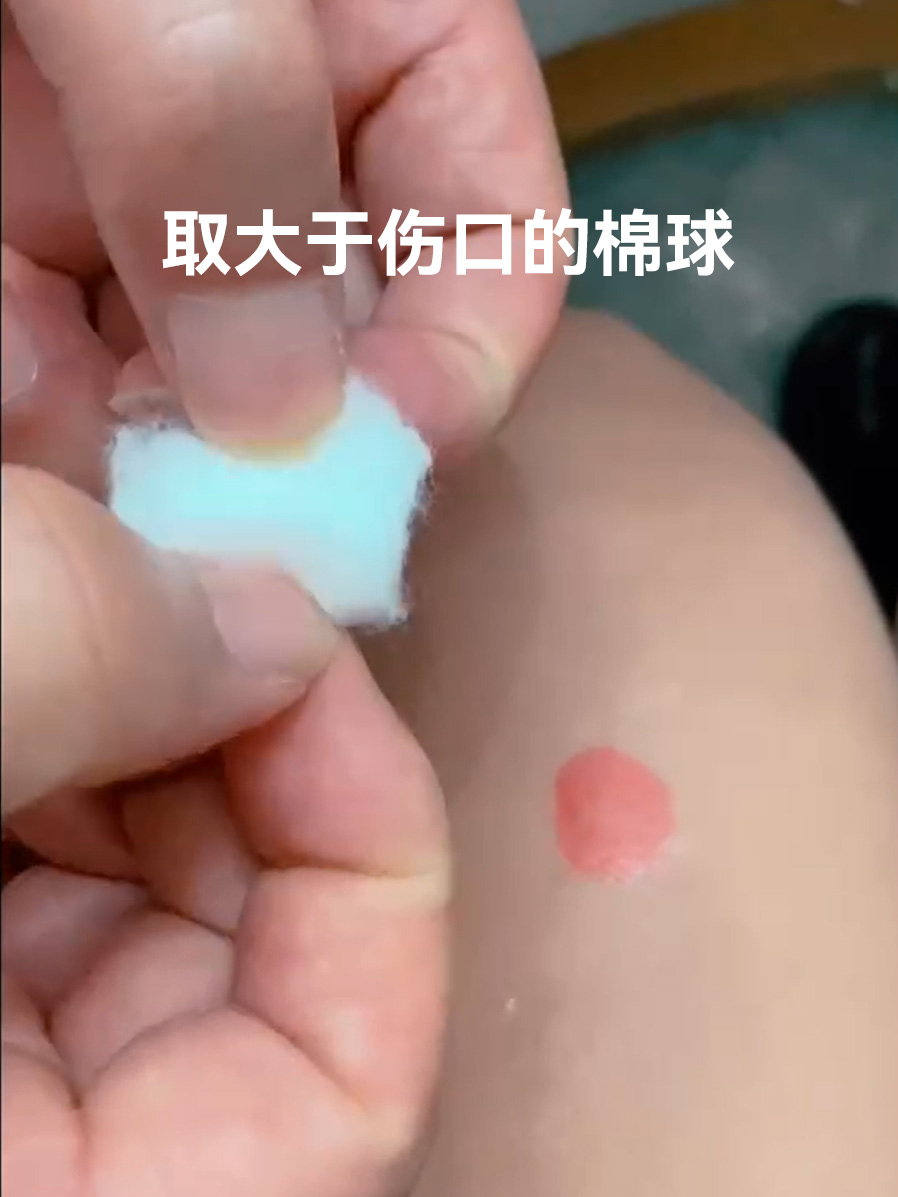 外伤湿敷使用方法