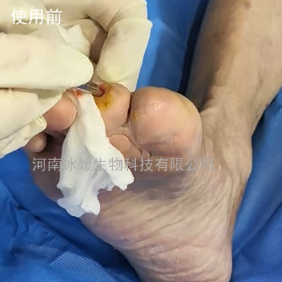 脚趾窦道