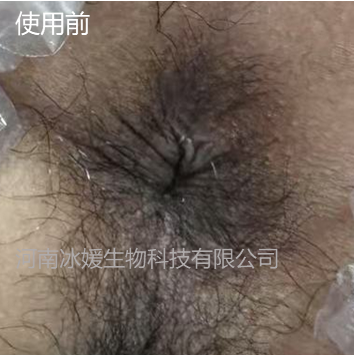 肛门瘙痒