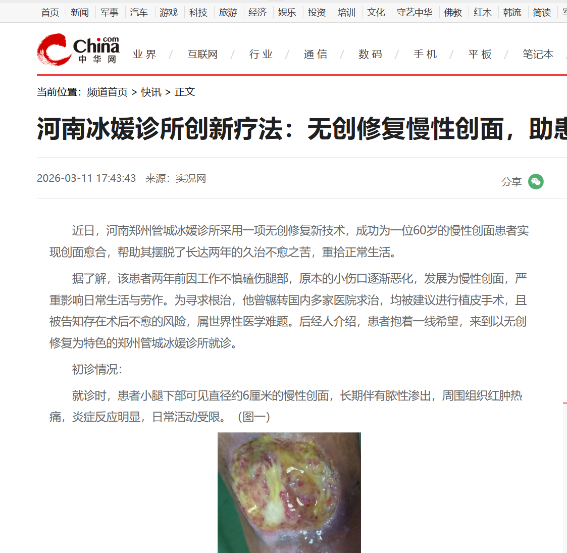 河南冰媛诊所创新疗法：无创修复慢性创面，助患者重获新生