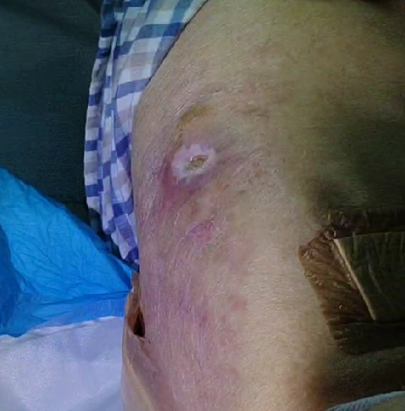 洞型皮下腔隙褥疮第一次使用探查