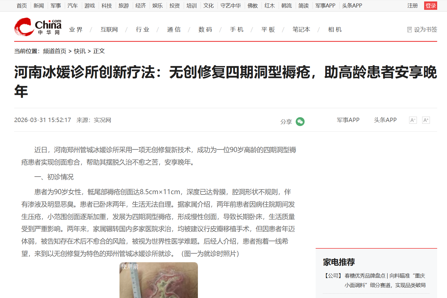 河南冰媛诊所创新疗法：无创修复四期洞型褥疮，助高龄患者安享晚年