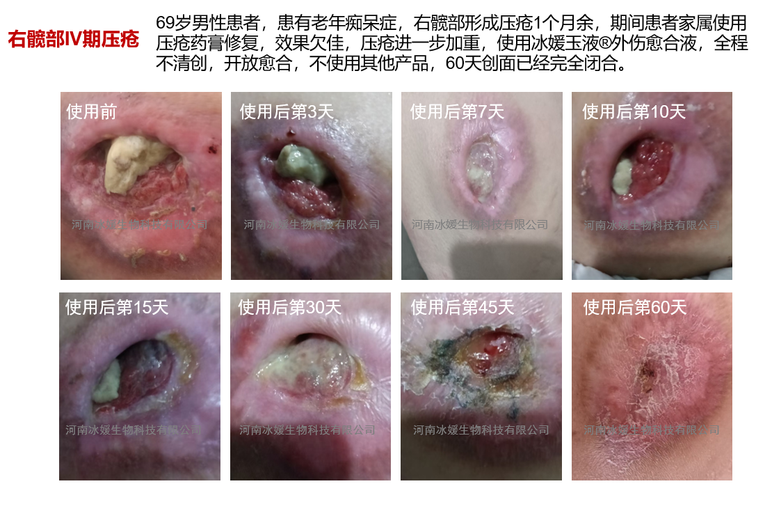 河南信阳褥疮患者使用实录