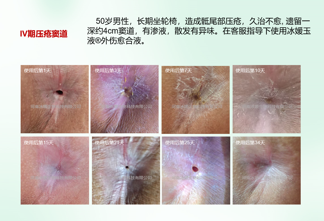 河南沁阳褥疮窦道患者使用实录
