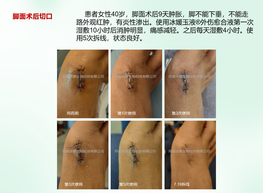 河南郑州术后伤口使用实录