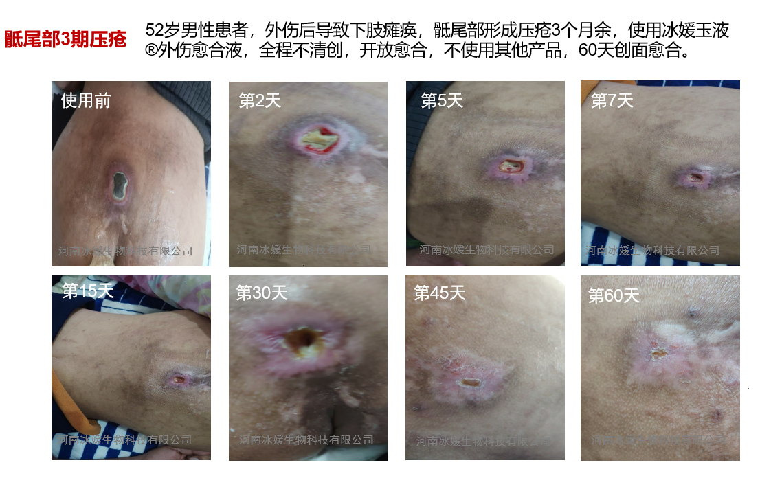 山东滨州压疮患者使用实录
