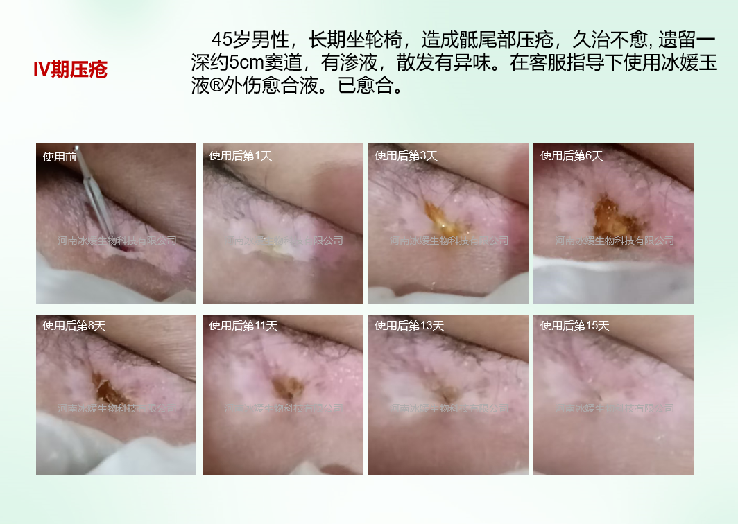 河南许昌患者使用实录