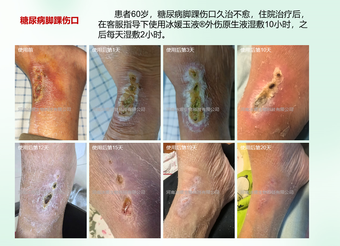 河南郑州糖尿病伤口患者使用实录
