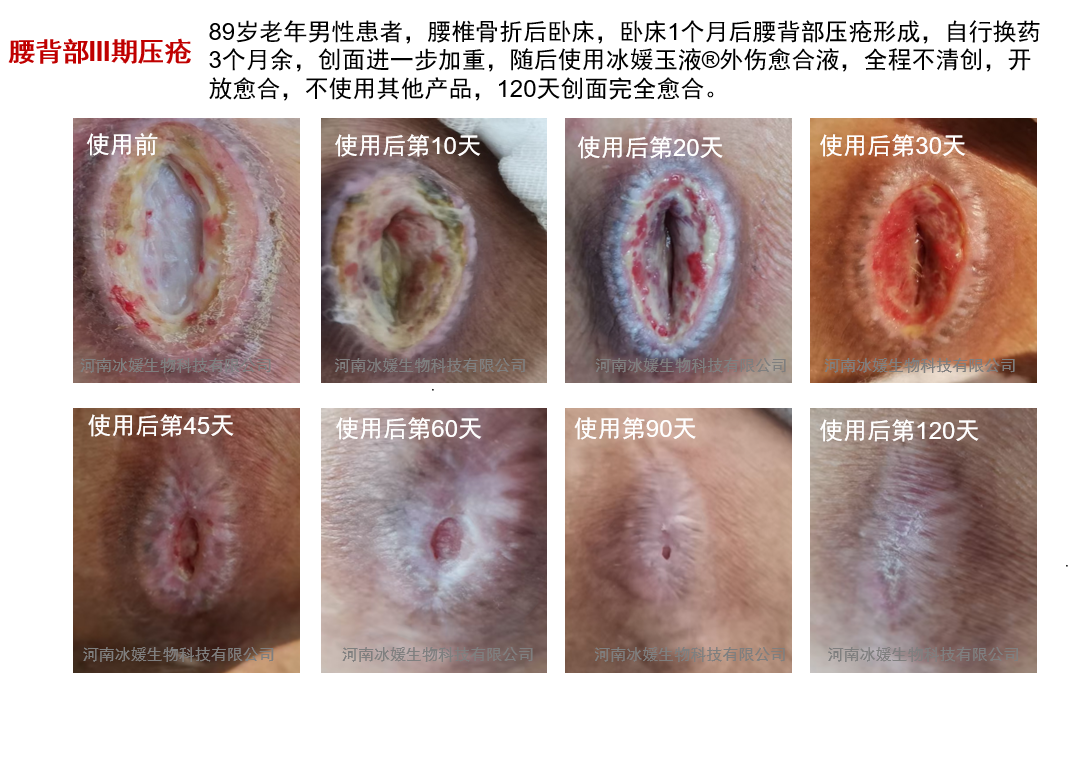 山东淄博患者使用实录