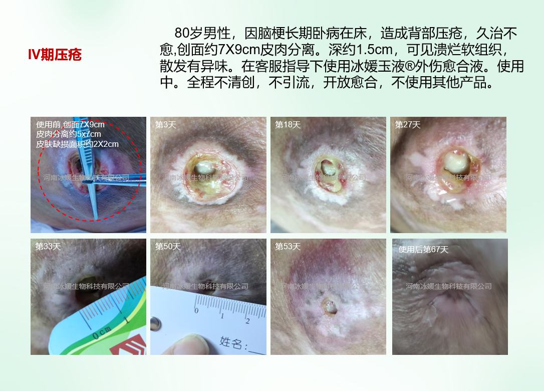 洞型皮下腔隙褥疮第一次使用探查