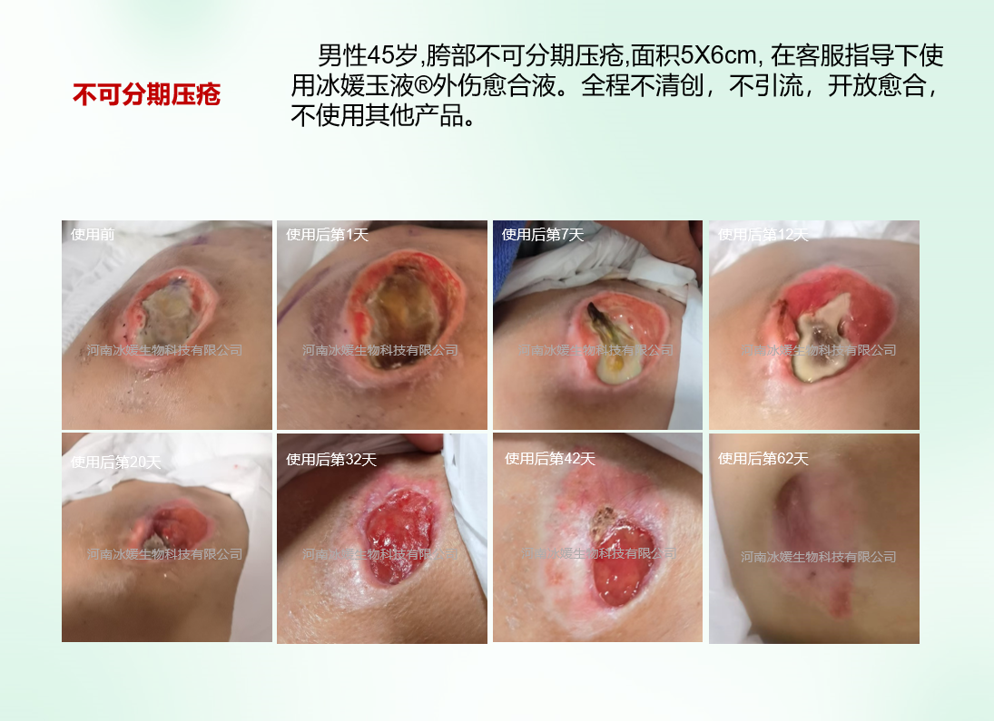 不可分期压疮