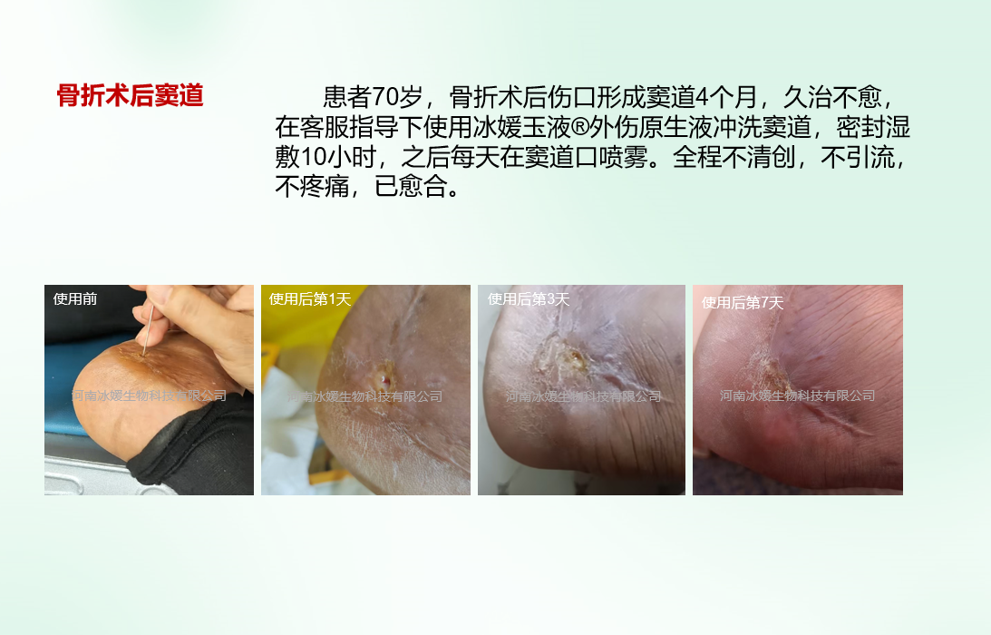 骨折术后窦道