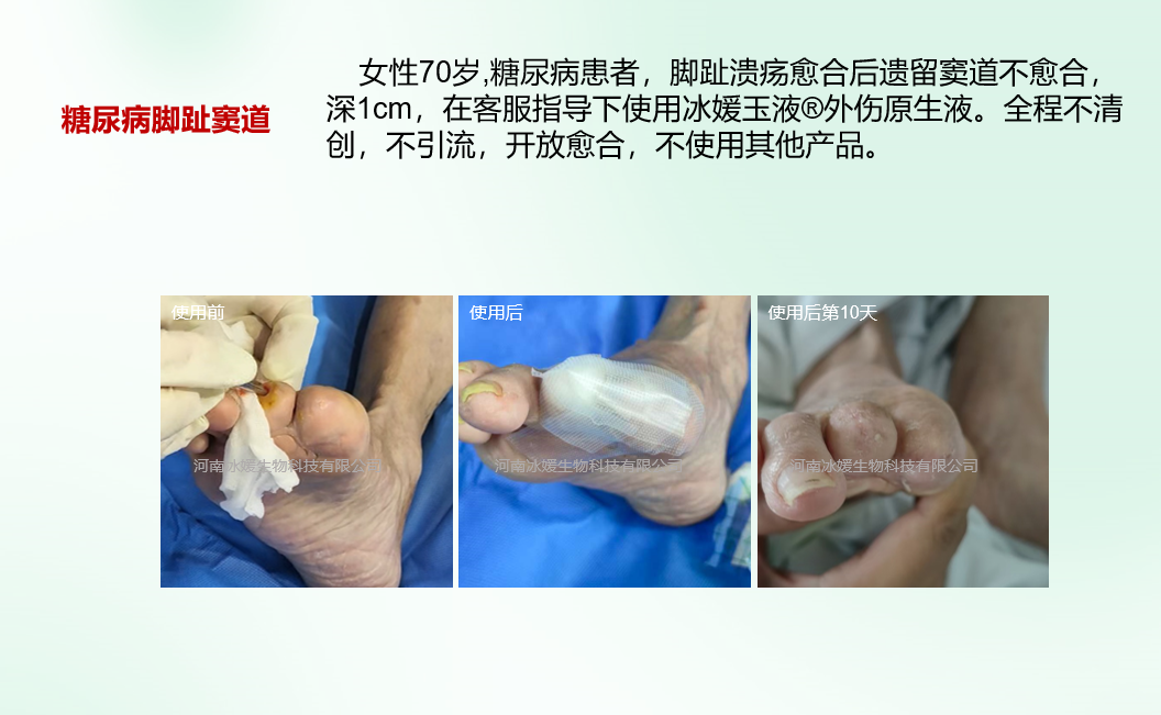 糖尿病足窦道